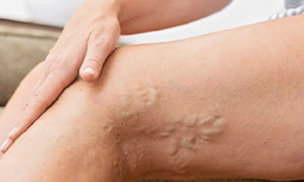 Врачи рассказали о современных методах лечения варикоза